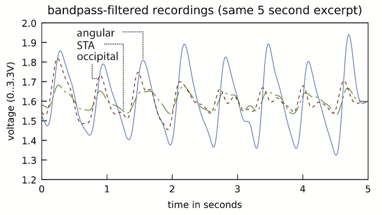 Glabella: Figure 10, bandpass filtered optical pulse reflection signal