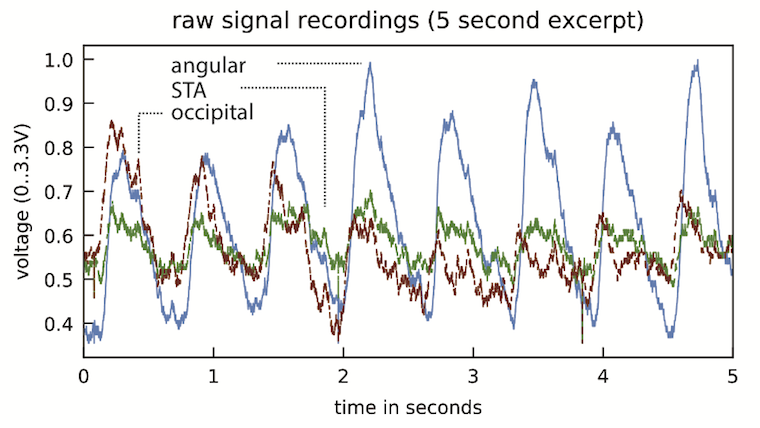 Glabella: Figure 9, raw optical pulse reflection signal captured
